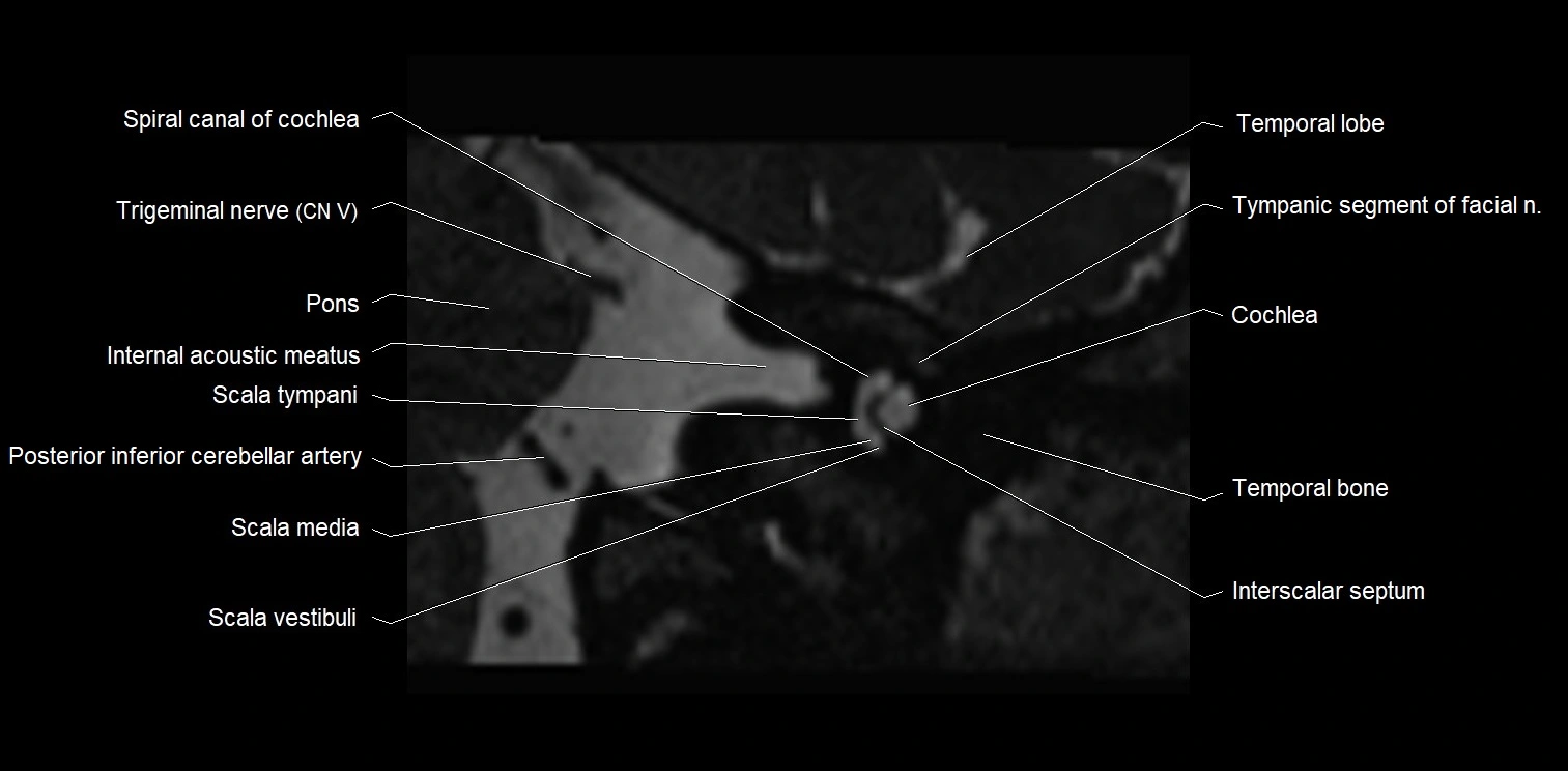 MRI Internal auditory meatus (IAM) coronal cross sectional labelled anatomy image 5.webp